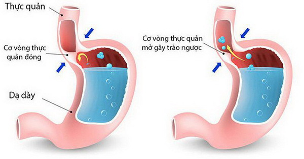 Co thắt tâm vị gây ra tình trạng trào ngược thức ăn và dịch vị.