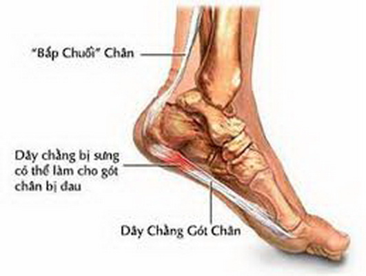 Dây chằng bị sưng có thể làm gót chân bị đau.