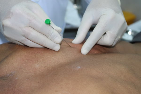 Cấy chỉ điều trị thoát vị đĩa đệm.