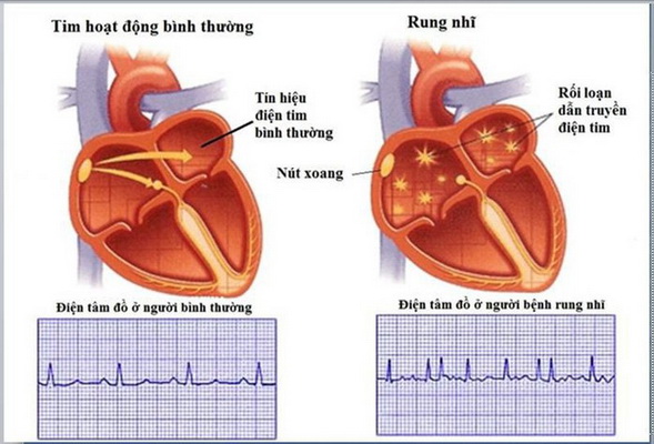 Hình ảnh rung nhĩ.