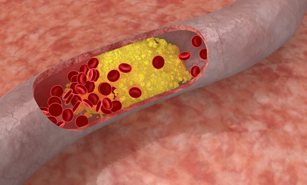 Cholesterol máu cao ảnh hưởng xấu đến đời sống tình dục.