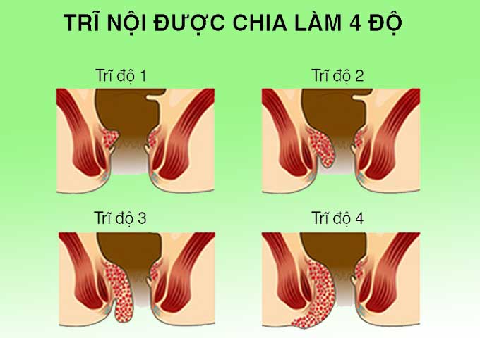 Bệnh trĩ nếu không điều trị sẽ dẫn đến các biến chứng nguy hiểm.