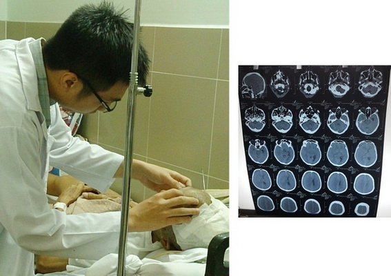 Bác sĩ thăm khám cho bệnh nhân sau mổ (trái) và phim chụp phát hiện chấn thương não của bệnh nhân.