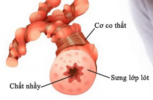 Hình ảnh phế quản người bị hen suyễn.