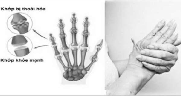 Thoái hóa khớp ngón tay