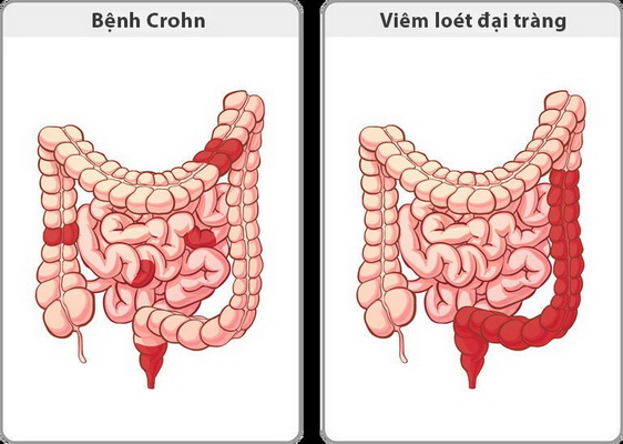 Bệnh Crohn, viêm loét đại tràng là những nguyên nhân gây chứng kém hấp thu.