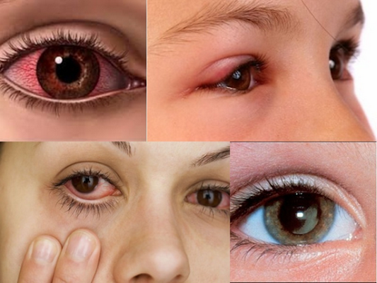 Mắt đỏ, chảy nước mắt, gỉ xung quanh mắt, mí mắt sưng tấy... là những triệu chứng điển hình của dị ứng mắt.