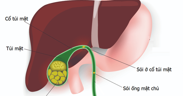 Hình ảnh sỏi túi mật