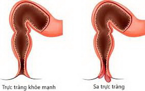 Hình ảnh trực tràng bị sa.