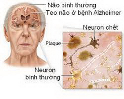 Bệnh Alzheimer ở người già
