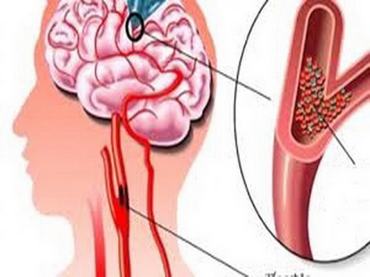 Rối loạn tuần hoàn não là một trong những nguyên nhân gây chóng mặt.