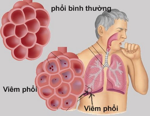 Viêm phổi là một biến chứng do sốt virus.