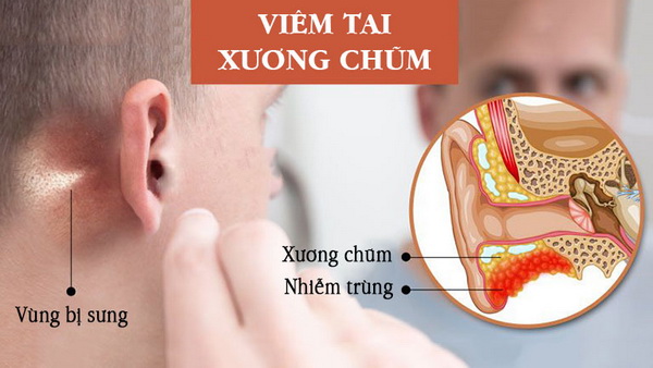 Cảnh giác với viêm tai xương chũm