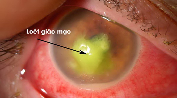 Viêm loét giác mạc nhiễm khuẩn: Nguy cơ cao gây mù lòa