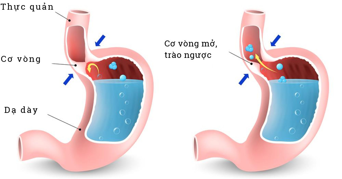 Trào ngược dạ dày có gây hôi miệng?