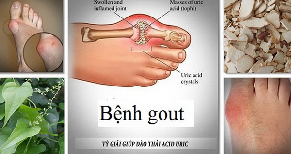 Tỳ giải giúp đào thải acid uric, là vị thuốc tốt trị bệnh thống phong.