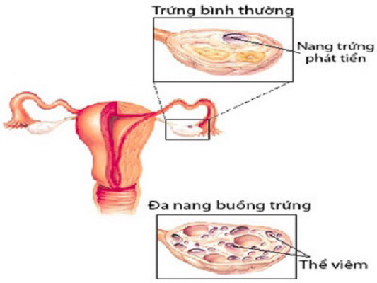 Hình ảnh buồng trứng đa nang.