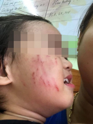 Xót xa hình ảnh bé gái ở Lạng Sơn bị bạn cùng lớp cào xước cả mặt.