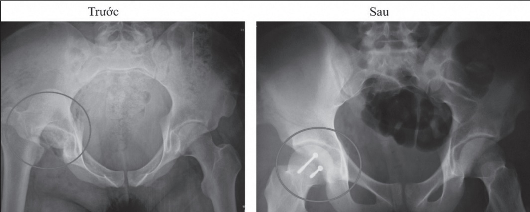 Ảnh chụp chỏm xương trước và sau khi phẫu thuật.