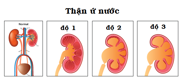 Thận ứ nước có thể gây suy giảm chức năng thận và gây tổn thương cấu trúc tế bào thận.