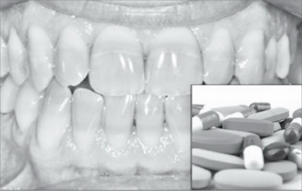 Một số kháng sinh làm ảnh hưởng xấu tới răng.