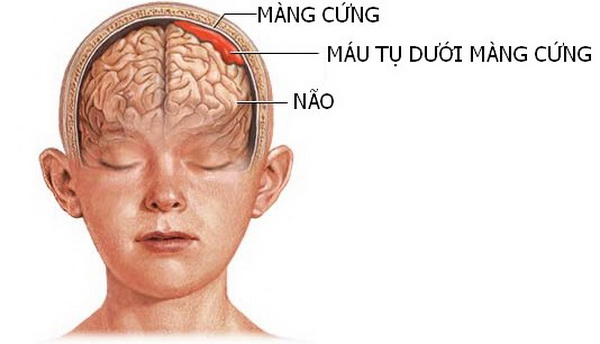 Hình ảnh máu tụ dưới màng cứng.