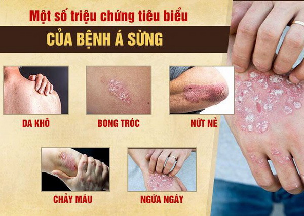 Triệu chứng tiêu biểu của bệnh á sừng.