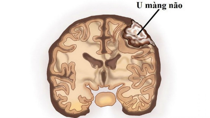 U màng não chiếm 15% các u trong sọ.