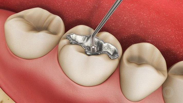 Chất trám răng chứa thủy ngân ảnh hưởng đến sức khỏe một số người.