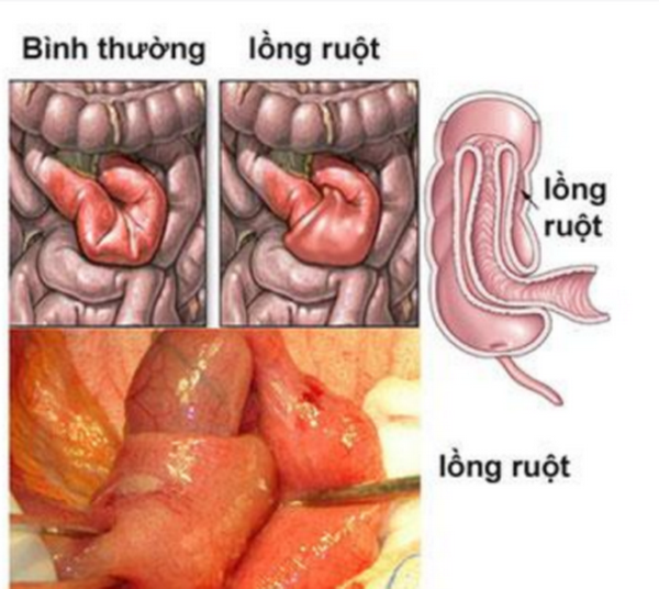 Hình ảnh lồng ruột.