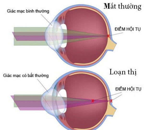 Mắt loạn thị.