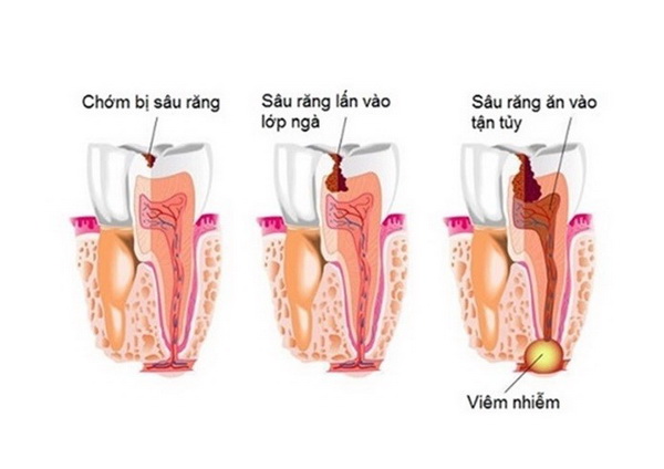 Sâu răng có thể gây nên viêm tủy xương.