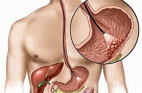 Khối u Carcinoid trong lòng dạ dày.