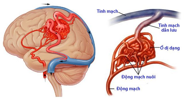 Hình ảnh dị dạng mạch máu - một nguyên nhân gây đột quỵ não.