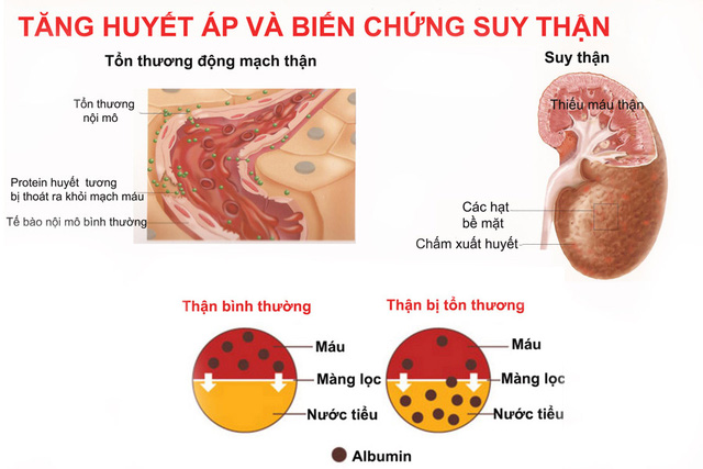 Tăng huyết áp và biến chứng suy thận.