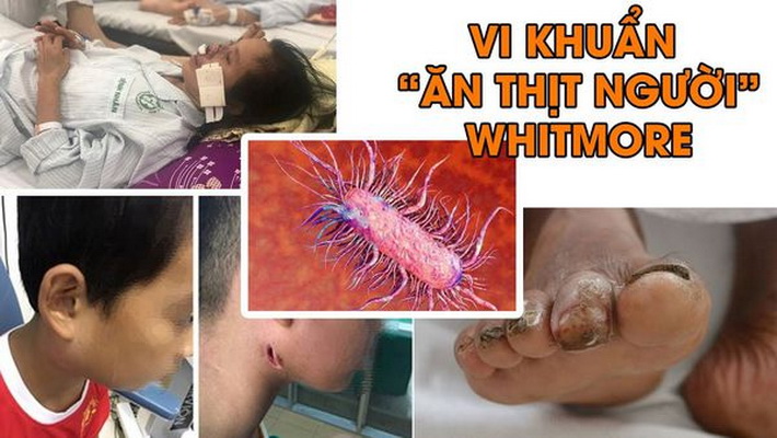 Sự nguy hiểm do vi khuẩn Whitmore gây ra cho người bệnh.