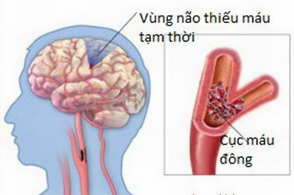 Nhồi máu não và xuất huyết não, nguyên nhân chính do cục máu đông trong lòng mạch làm nghẽn mạch.