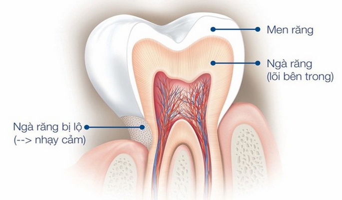 Răng nhạy cảm hình thành khi phần ngà răng bị ăn mòn.