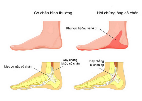 Hội chứng ống cổ chân xảy ra khi có sự chèn ép dây thần kinh bên trong đường hầm.