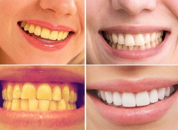 Tình trạng các mảng ố màu vàng nâu trên răng rất thường gặp.