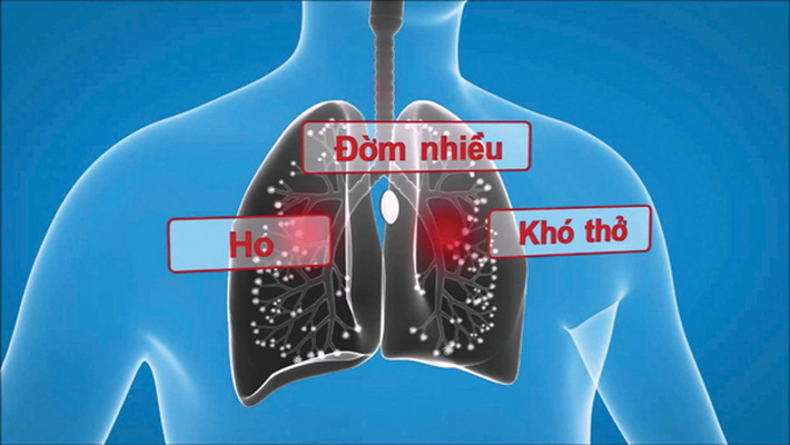 Đàm nhiệt khái thấu là chứng  hay gặp trong một số bệnh hô hấp.