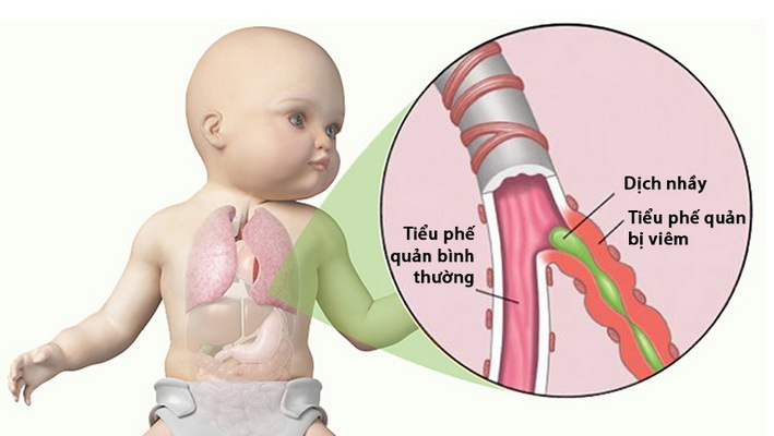 Phòng Ngừa Viêm Tiểu Phế Quản ở Trẻ Em Trạm Y Tế Phường Phú Thọ Hòa 