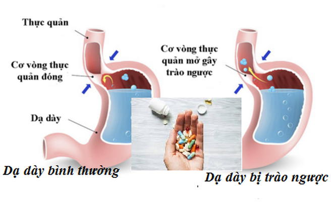 Trào ngược dạ dày - thực quản.