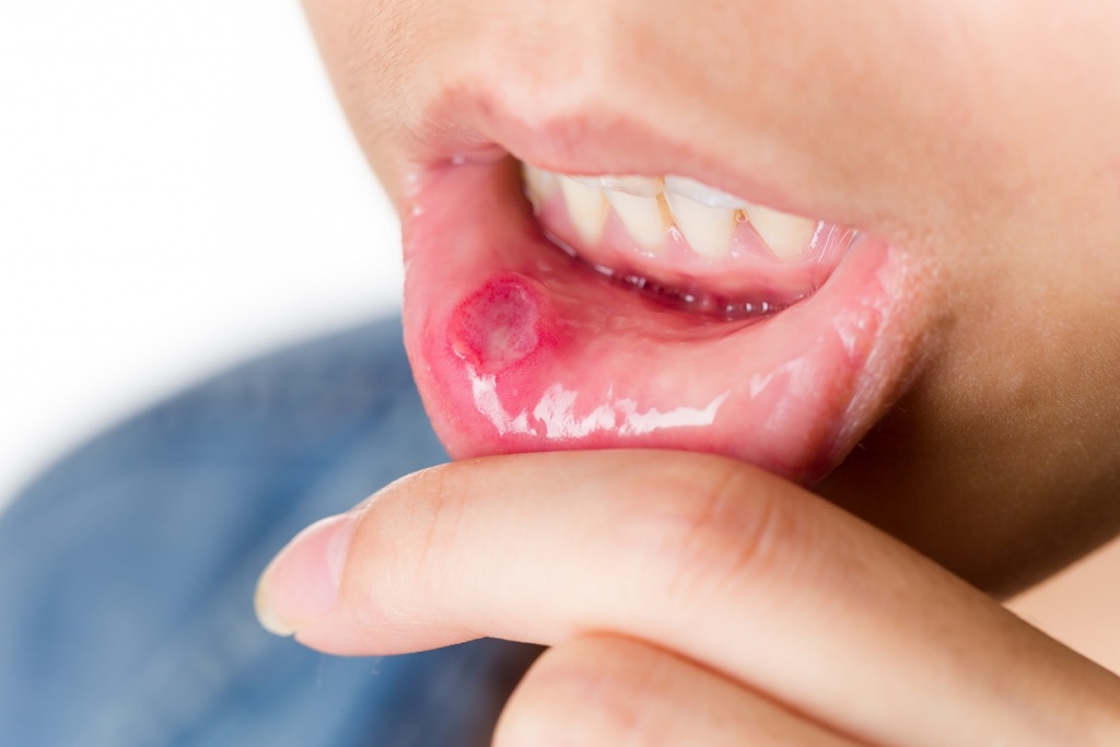 Các yếu tố nguy cơ gây ung thư miệng