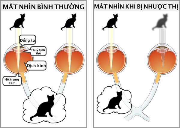 Hình ảnh minh hoạ giữa mắt nhìn bình thường và mắt bị nhược thị.