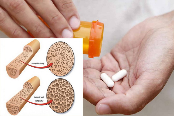 Người cao tuổi cần cảnh giác với một số thuốc có thể gây loãng xương