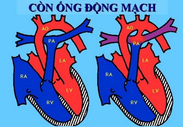 Hình ảnh còn ống động mạch.