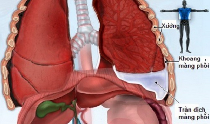 Hình ảnh dịch xuất hiện nhiều trong khoang màng phổi người bệnh.