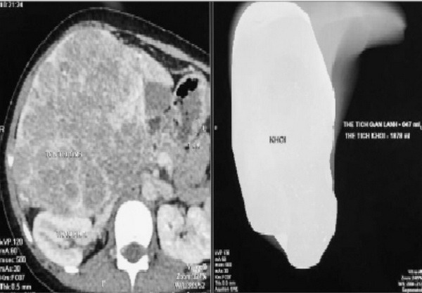 Khối u chiếm toàn bộ phần gan phải trên phim chụp CT bụng.