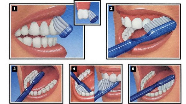 Để phòng sâu răng, cần chải răng đúng cách 3 lần/ngày.